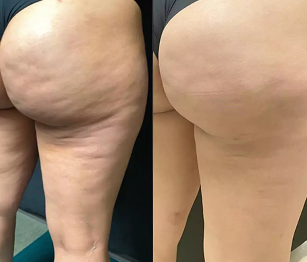 Before and After